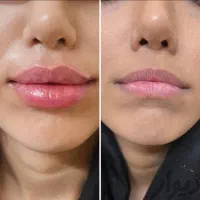 لیزر موهای زائد۲۰۲۵، بوتاکس،فیلر توسط پزشک|خدمات آرایشگری و زیبایی|تهران, جوادیه|دیوار