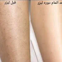 لیزر موهای زائد/ریمو تتو/لاغری/ژل/بوتاکس|خدمات آرایشگری و زیبایی|تهران, سعادت‌آباد|دیوار