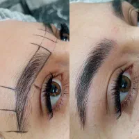 میکروبلیدینگ فیبروز