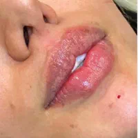 اف ویژه ژل بوتاکس بندرعباس|خدمات آرایشگری و زیبایی|بندرعباس, |دیوار