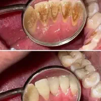 جرمگیری دندان تقریبا رایگان|خدمات آرایشگری و زیبایی|بیرجند, |دیوار