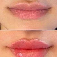 کلینیک ژل بوتاکس پاک کردن تتو با لیزر