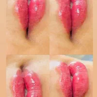 ژل ، بوتاکس و مزوژل جوانساز و روشن کننده