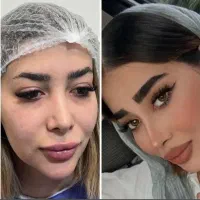 لیپوماتیک و ابدو
