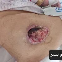 پانسمان نوین زخم بستر / دیابتی / سوختگی / سرطانی|خدمات آرایشگری و زیبایی|ارومیه, |دیوار