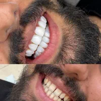 تخفیف ونیر کامپوزیت