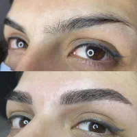 تخفیف 50درصدی فیبروز ابرو