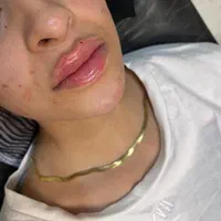 تخفیف جشنواره فیلر ژل لب و صورت یافت اباد فلاح|خدمات آرایشگری و زیبایی|تهران, تولید دارو|دیوار