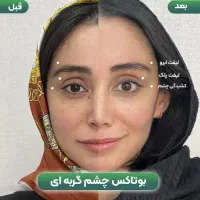 اصلاح لاغری چهره بوتاکس چشمگربه فیلرلب روسی پزشک