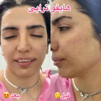 پلاژن تراپی /هایفو تراپی /لیزر بدن/کربوکسی|آرایشگاه و سالن‌های زیبایی|مشهد, کارگران|دیوار