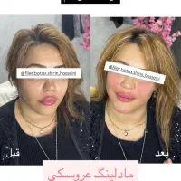ژل، بوتاکس،آنزیم،مزوتراپی پی ار پی،فیلر بادی