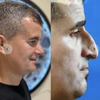 عمل بینی فقط با 30 میلیون تومن با شرایط پرداخت