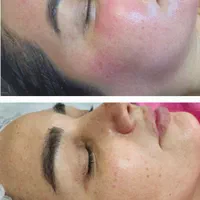 فیشیال مزوتراپی الکترولیز پاکسازی و آموزش در مطب|خدمات آرایشگری و زیبایی|اهواز, گلستان|دیوار