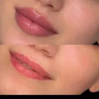 تخفیف ویژه مدل فیلر لب چونه گونه فول