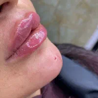 جشنواره یلدایی ژل و بوتاکس پیکرتراشی لیفت سینه