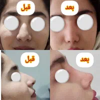 عمل زیبایی بینی|خدمات آرایشگری و زیبایی|زنجان, |دیوار