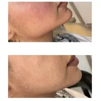 بوتاکس ،فیلر، فیشیال،هایفو ،لیزرکیوسویچ|خدمات زیبایی و سلامت|کرمانشاه, |دیوار