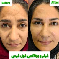 تزریق انواع بوتاکس  ژل آنزیم بینی نخ جوانسازی|خدمات آرایشگری و زیبایی|صدرا-فارس, فاز ۱|دیوار