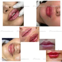 قیمت باورنکردنی فیشیال 500t،ژل بوتاکس حجامت