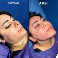 سوپرساکشن غبغب همراه بازاویه سازی تخصصی گردنُ صورت|خدمات آرایشگری و زیبایی|تهران, پاسداران|دیوار