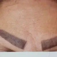 ژل لب ژل گونه سیب گونه.  بوتاکس. . زاویه فک.