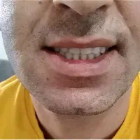 ساخت انواع دندان مصنوعی