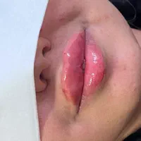 تزریقات ژل و بوتاکس|خدمات آرایشگری و زیبایی|گرگان, |دیوار