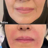 فیلر ژل بوتاکس تخفیف جشنواره