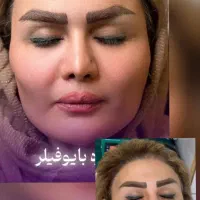 ژل طبیعی فیلر بوتاکس(کلینیک زیبایی گلد)