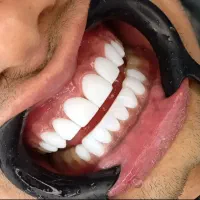 جشنواره کامپوزیت ،روکش..