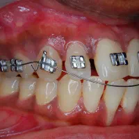 ارتودنسی رایگان کودکان ۶تا ۱۰ سال|خدمات آرایشگری و زیبایی|تهران, خاک سفید|دیوار