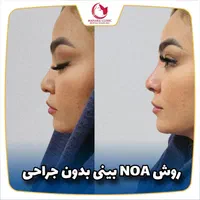 یانگ فیس صورت Noa بینی ابرو غبغب سینه باسن شکم پلک|خدمات آرایشگری و زیبایی|مشهد, هفت تیر (حافظ)|دیوار