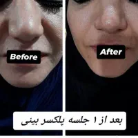 فشیال . مزونیدلینگ‌. خال برداری و آموزش