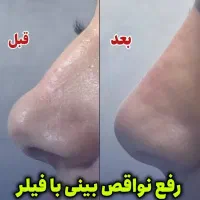 کانتورینگ لیفت فیلر بوتاکس مزو