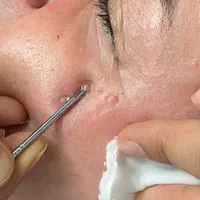 خالبرداری ،رفع کک ومک ،برداشتن میخچه توسط پزشک|خدمات آرایشگری و زیبایی|کرج, شهرک یاس جنوبی|دیوار