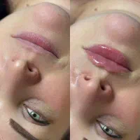 مطب زیبایی پوست مو لیزر الکساندرایت