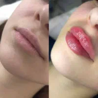 زیبایی،فیلر،بوتاکس