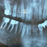 دندان سالم فروشی ویژه دانشجویان