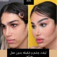 لیفت فول فیس صورت لیفت چشم گربه ای بدون عمل جراحی