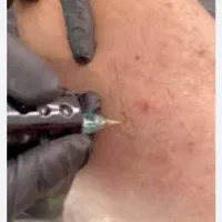 برداشتن انواع خال.جراحی غدد.جای سالک.زخم.سوختگی|خدمات آرایشگری و زیبایی|مشهد, هنرستان|دیوار