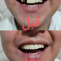 دندان مصنوعی از دم قسط