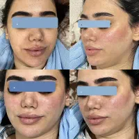 ژل بوتاکس پیرسینگ مزوژل آنزیم آموزش