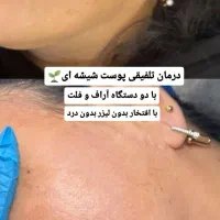 پاکسازی پوست ودرمان لک