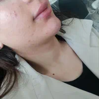 فیلر بادی تخصصی