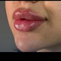 لیزر تضمینی، بوتاکس فیلر مزوتراپی زگیلprp فیشیال