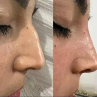 برداشتن خال و زگیل.جوانسازی.بوتاکس.آنزیم.فیلر|خدمات آرایشگری و زیبایی|کرمانشاه, |دیوار