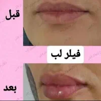 کلینیک لیزربوتاکس مزو دکترعلی حسین‌ زاده پرندبیمه|خدمات آرایشگری و زیبایی|پرند, |دیوار