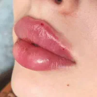 تزریق فیلر و بوتاکس/لب،خط خنده،چانه،رفع چین و چروک