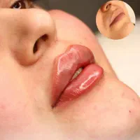 جشنواره تزریق ژل هایفو فیلر بادی