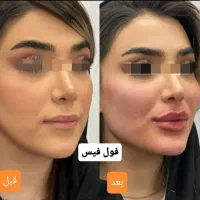 تخفیفات بلک فرایدی ژل و بوتاکس درمطب|خدمات آرایشگری و زیبایی|خرم‌آباد, |دیوار